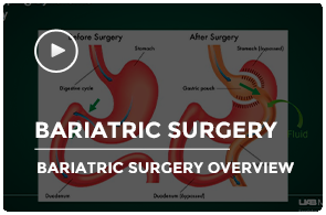 Bariatric Surgery Video