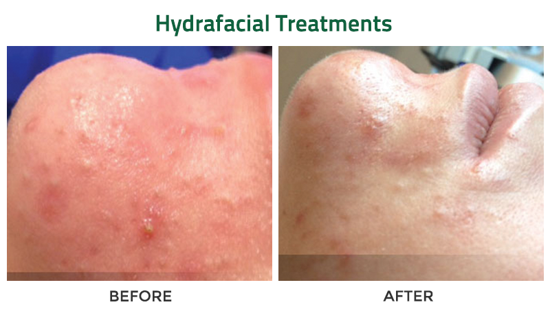 Up close before and after photos of a Caucasian individual's chin with Hydrafacial treatments