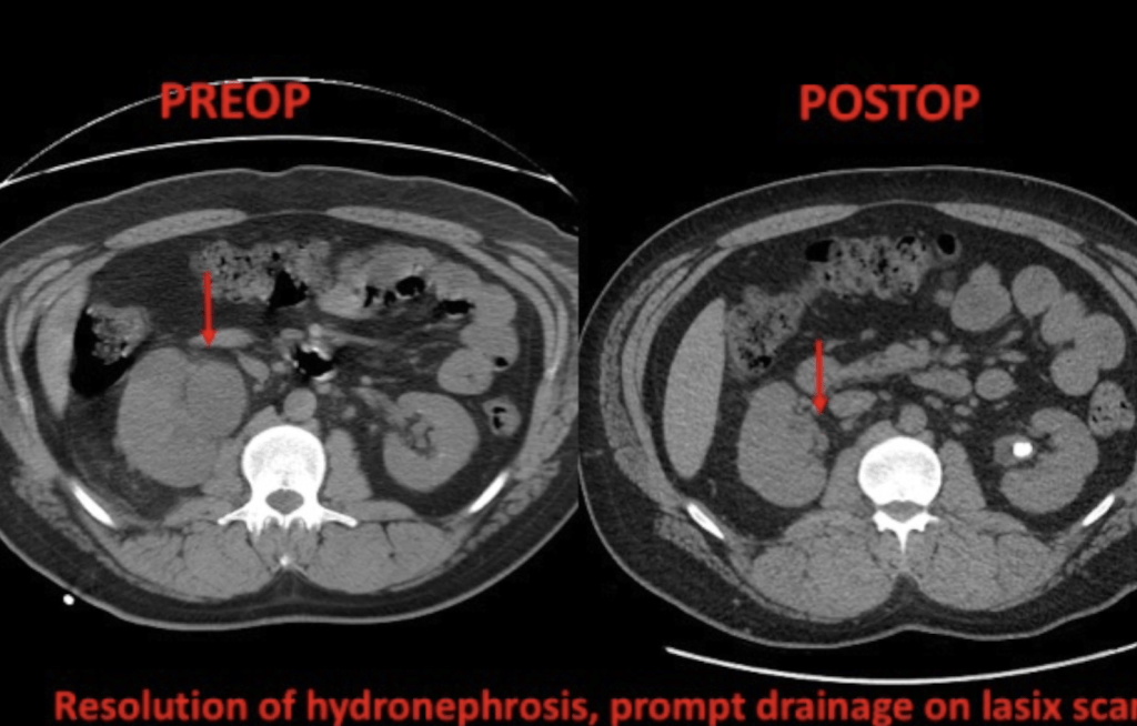 Robotic Ureteral Stricture Treatment with Appendix Interposition