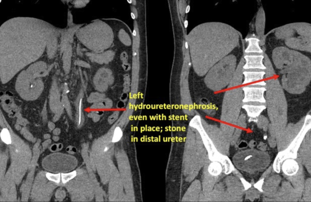 Ureteral Reimplant Bladder Flap