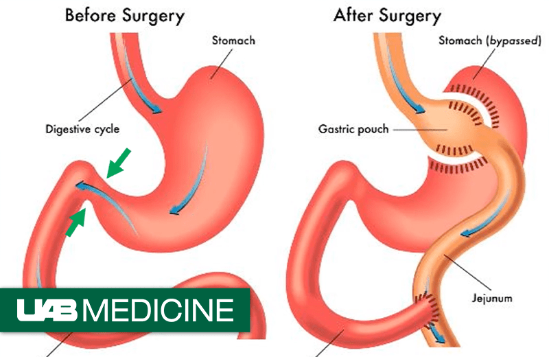 before and after bariatric surgery thumbnail